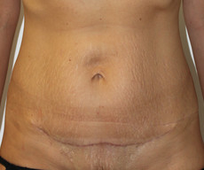 Abdominoplasty - Pacient, abdominoplasty - After 3 months