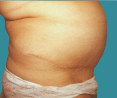 Abdominoplasty - 46 years old patient, abdominoplasty - After 3 months