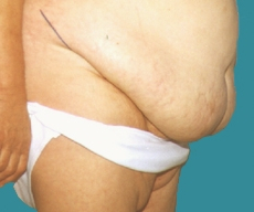 Abdominoplasty - 48 years old patient, abdominoplasty - After 12 months