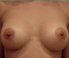 Breast enlargement - Breast enlargement with Matrix 335 implants - After 6 months