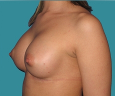 Breast enlargement - 26 years old patient, Matrix implants 280 cm3 left breast, 295 right breast - After 2 months