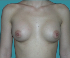 Breast enlargement - 20 years old patient, implants Matrix 295 cm3, submuscular position, inframammary approach - After 1 month