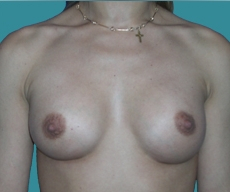 Breast enlargement - 23 years old patient, implants Mentor 315 cm3, submuscular position, inframammary approach - After 4 months