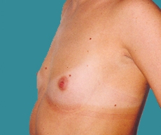 Breast enlargement - Breast enlargement with Matrix 295 implants - After 