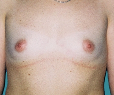 Breast enlargement - Breast enlargement with Matrix 280 implants - After 