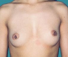 Breast enlargement - Breast enlargement with Mentor 330 implants - After 