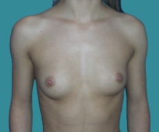 Breast enlargement - 20 years old patient, implants Mentor 350 cm3, submuscular position, inframammary approach - After 3 months
