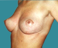 Breast lift - 23 years old patient, 2 pregnancies - mastopexy - After 