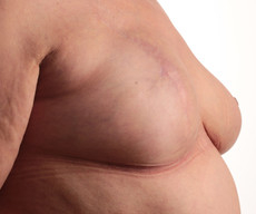 Breast reconstruction - Pacienta 61 ani cu mastectomie completa san dreapta si mamopexie san stanga pentru simetria sanilor. Reconstructie san drept prin implant proteza Mentor rotund 375CC subpectoral. - After 5 months