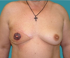 Breast reconstruction - Right breast reconstruction with rotated flap on a 48 years old patient - After 