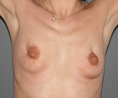 Prophylactic mastectomy - Pacienta de 49 ani cu multiple interventii in antecedente pentru fibroadenom. Se practica mastectomie subcutanata profilactica pe incizii inframamare si reconstructie imediata cu proteze Mentor 300CC subpectoral. - After 2 years