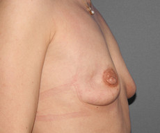 Prophylactic mastectomy - Pacienta de 49 ani cu multiple interventii in antecedente pentru fibroadenom. Se practica mastectomie subcutanata profilactica pe incizii inframamare si reconstructie imediata cu proteze Mentor 300CC subpectoral. - After 2 years