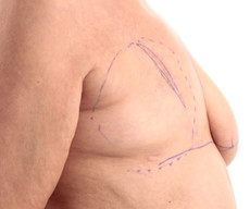 Breast reconstruction - Pacienta 61 ani cu mastectomie completa san dreapta si mamopexie san stanga pentru simetria sanilor. Reconstructie san drept prin implant proteza Mentor rotund 375CC subpectoral. - After 5 months