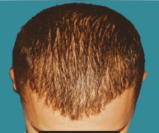Hair transplant - Hair transplant, result after 2 sessions - After 3 months after the second transplant