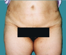 Liposuction - 37 years old patient, liposuction abdomen - After 1 month