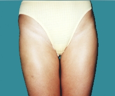 Liposuction - 29 years old patient, liposuction inner+outer thighs and hips - After 6 months