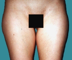 Liposuction - 30 years old patient, liposuction inner and outer thighs - After 3 months