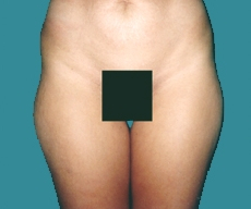 Liposuction - 29 years old patient, liposuction inner+outer thighs and hips - After 6 months