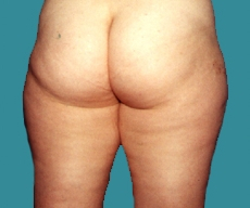 Liposuction - 36 years old patient, liposuction inner and outer thighs - After 4 months