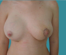 Breast lift with implants - Poland syndrome, right breast 300 round implant, left breast Mammopexia - After 