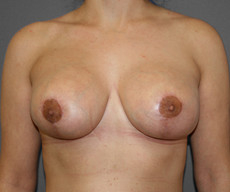 Breast lift with implants - Pacienta de 32 de ani, mamopexie cu proteze Mentor rotunde 300cc, subpectoral - After 3 months