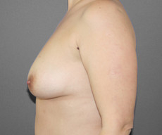 Breast lift with implants - Pacienta de 40 de ani, mamopexie cu proteze Mentor rotunde 300 g - After 1 month