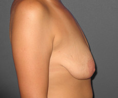 Breast lift with implants - Pacienta de 31 de ani, mamopexie cu proteze Mentor rotunde 325cc, subpectoral - After 3 months