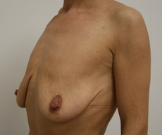 Breast lift with implants - Pacienta de 38 de ani, mamopexie cu proteze Mentor rotunde 250cc, subpectoral - After 3 months