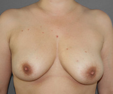 Breast lift with implants - Pacienta de 36 de ani, mamopexie cu proteze Mentor rotunde 275cc sanul stang, 300cc sanul drept, subpectoral - After 3 months