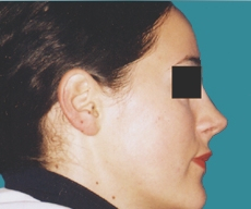 Rhinoplasty - 24 years old patient, rhinoplasty - After 3 months