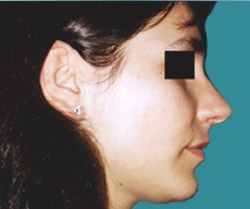 Rhinoplasty - 27 years old patient, rhinoplasty - After 3 months