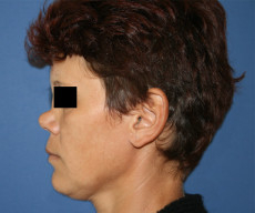 Rhinoplasty - Pacienta de 35 de ani, nas in sa, rinoseptoplastie prin tehnica deschisa, cu grefon costal - After 1 week